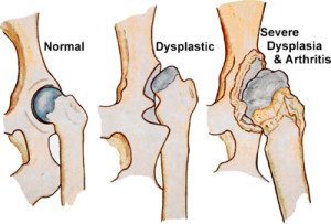 Normal vs Dysplastic Hip joints